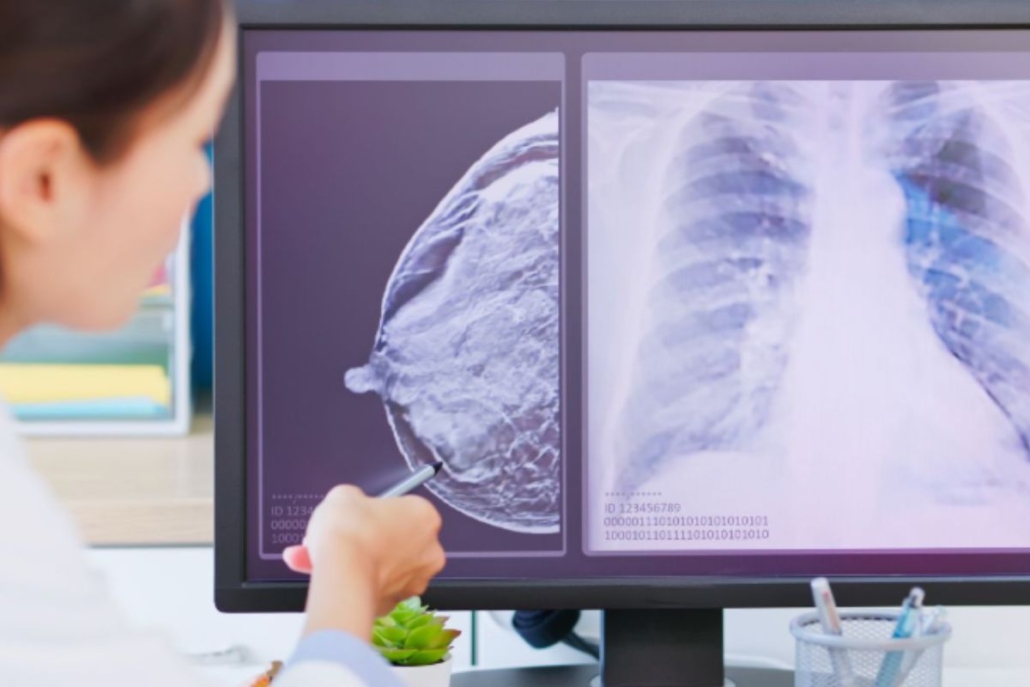 Poder da Progesterona Certa: uma luz sobre o Câncer de Mama