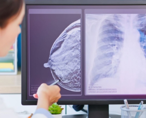 Poder da Progesterona Certa: uma luz sobre o Câncer de Mama